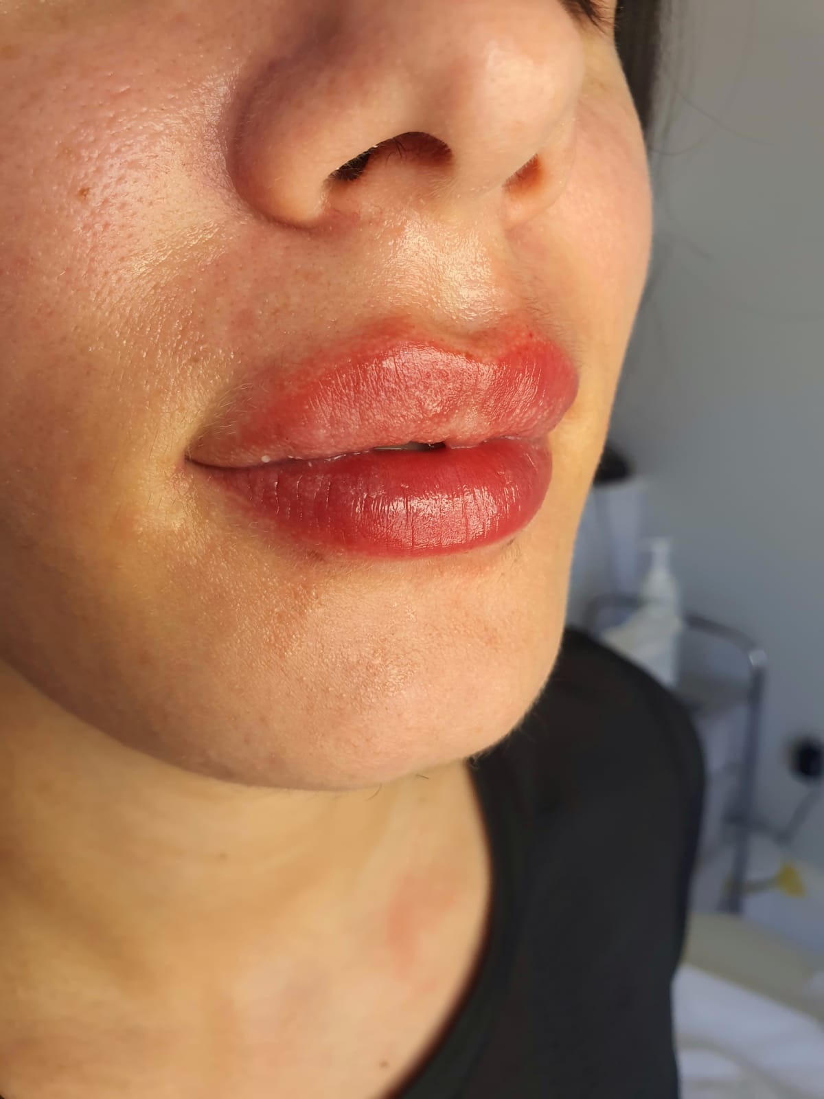 Lip Augmentation